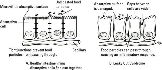 Syndrome du blé et de l'intestin qui fuit