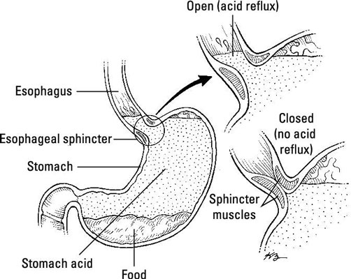 Comment le régime aide avec le reflux acide